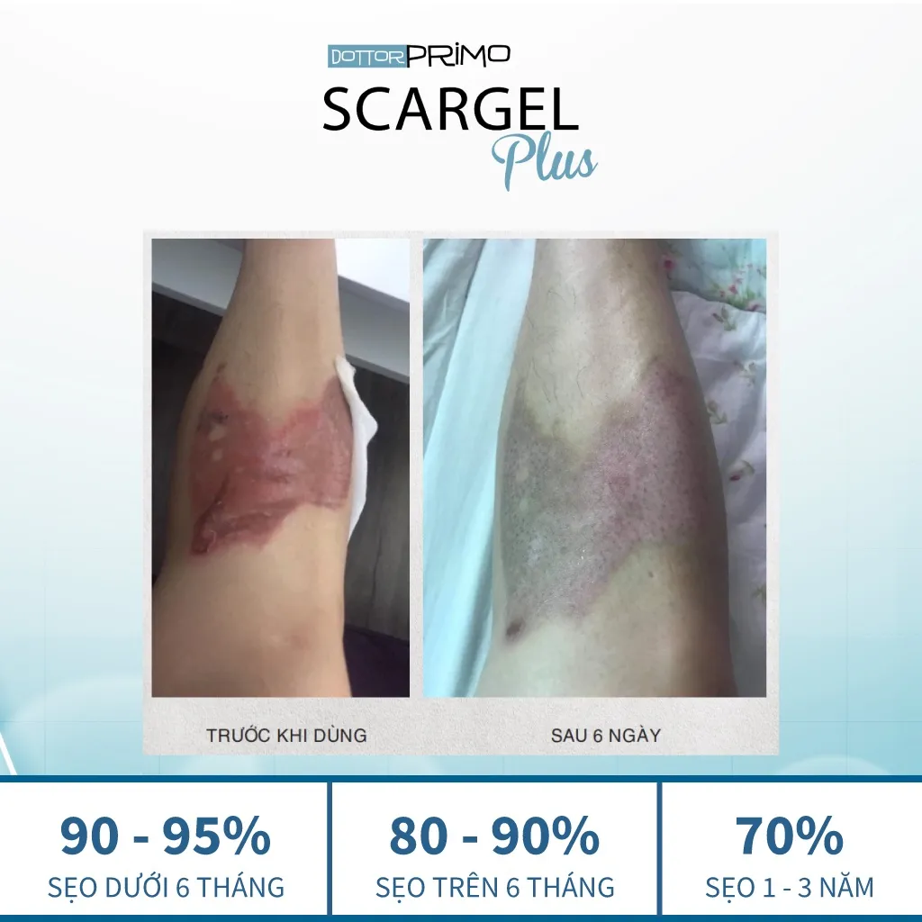 Ảnh Kem Làm Mờ Sẹo DottorPrimo Scargel Plus - Duy Nhất Dùng Được Khi Vết Thương Còn Ướt 3
