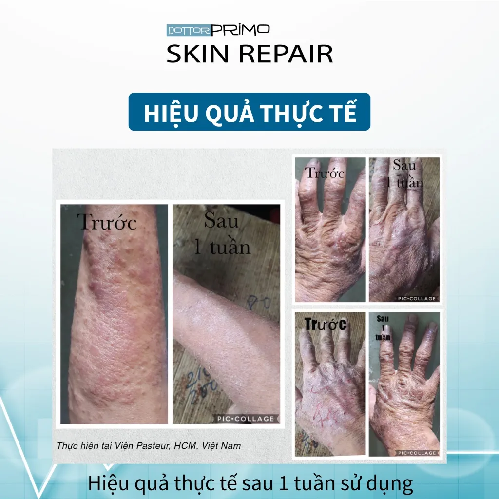 Ảnh Kem Viêm Da Cơ Địa, Chàm Da, Eczema, Da Nứt Nẻ DottorPrimo Skin Repair (Tuýp 20-50ml) 2