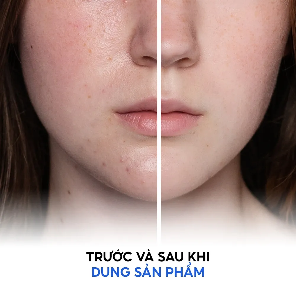 Ảnh Sữa rửa mặt dành cho da dầu mụn Tenamyd Cosmetic 120gam 3